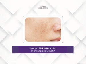 Mengapa Flek Hitam Bisa Muncul Pada Wajah?